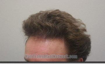 Hair restoration procedure results