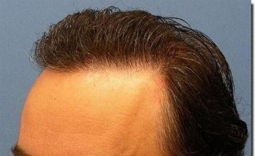 Hair restoration procedure results