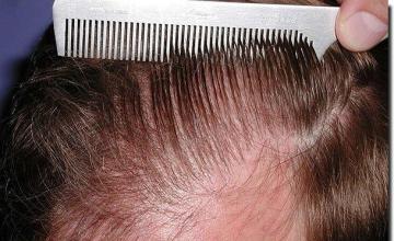 Hair restoration procedure results