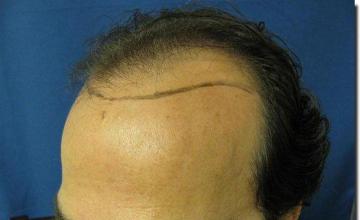 Hair restoration procedure results