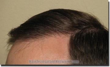 Hair restoration procedure results