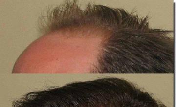 Hair restoration procedure results