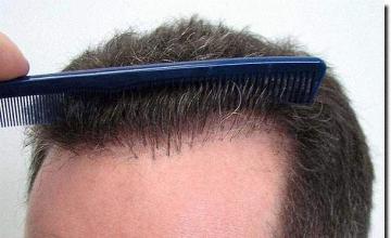 Hair restoration procedure results