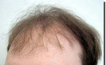 Hair restoration procedure results