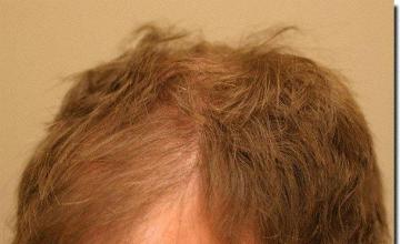 Hair restoration procedure results