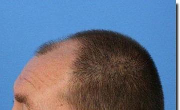 Hair restoration procedure results