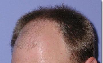 Hair restoration procedure results