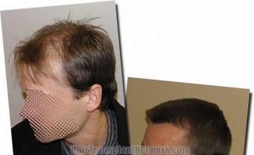Hair restoration procedure results