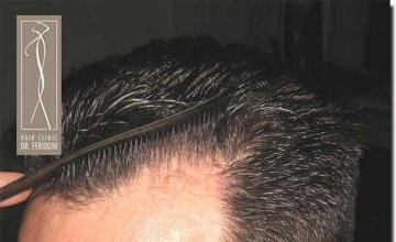 Hair restoration procedure results