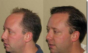 Hair restoration procedure results