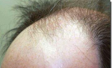 Hair restoration procedure results