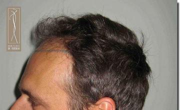 Hair restoration procedure results