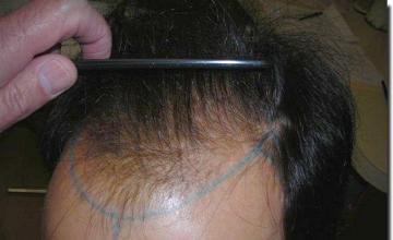 Hair restoration procedure results