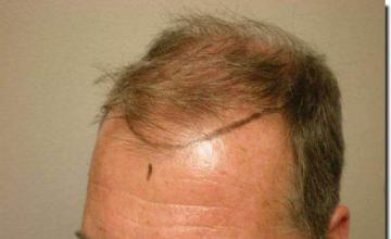 Hair restoration procedure results