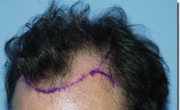 Hair restoration procedure results