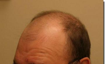 Hair restoration procedure results