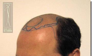 Hair restoration procedure results