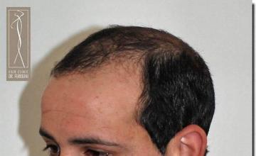 Hair restoration procedure results