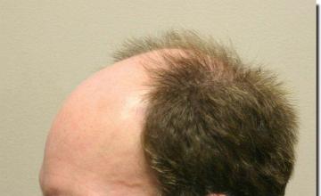 Hair restoration procedure results