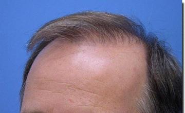 Hair restoration procedure results