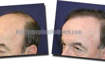 Hair restoration procedure results