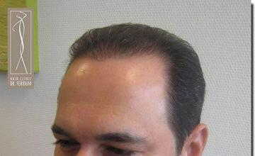 Hair restoration procedure results