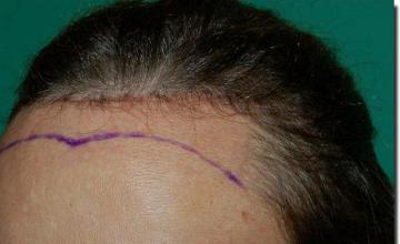 Hair restoration procedure results