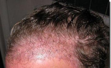 Hair restoration procedure results