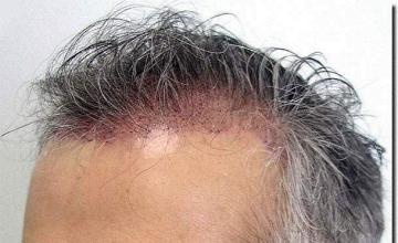 Hair restoration procedure results