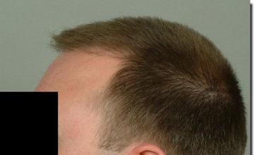 Hair restoration procedure results