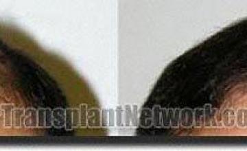 Hair restoration procedure results