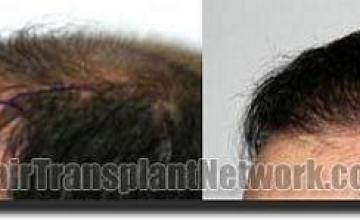 Hair restoration procedure results