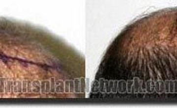 Hair restoration procedure results
