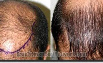Hair restoration procedure results