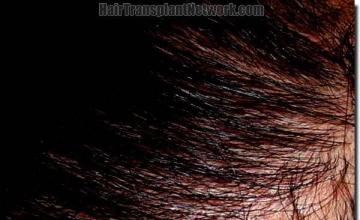 Hair restoration procedure results