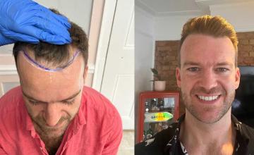 Front before and after FUE surgery