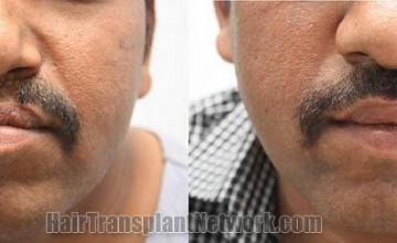 Hair transplantation surgery before and after images