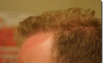 Hair restoration procedure results