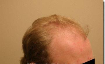 Hair restoration procedure results