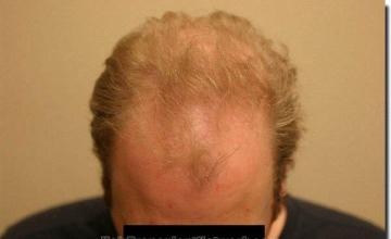 Hair restoration procedure results