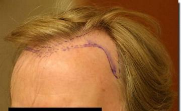 Hair restoration procedure results