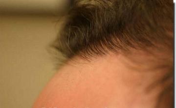 Hair restoration procedure results