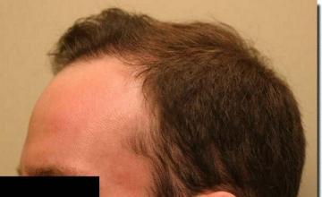 Hair restoration procedure results