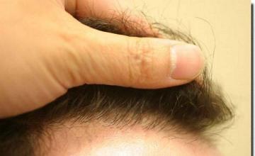 Hair restoration procedure results