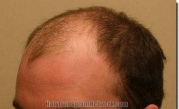 Hair restoration procedure results