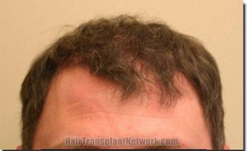 Hair restoration procedure results