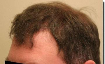 Hair restoration procedure results