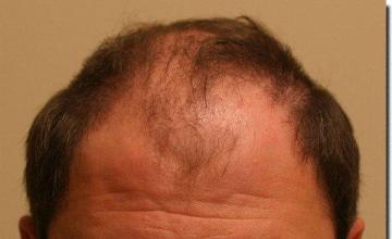 Hair restoration procedure results