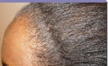 Hair restoration procedure results