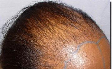 Hair restoration procedure results